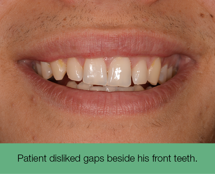 1. Patient disliked gaps beside his front teeth