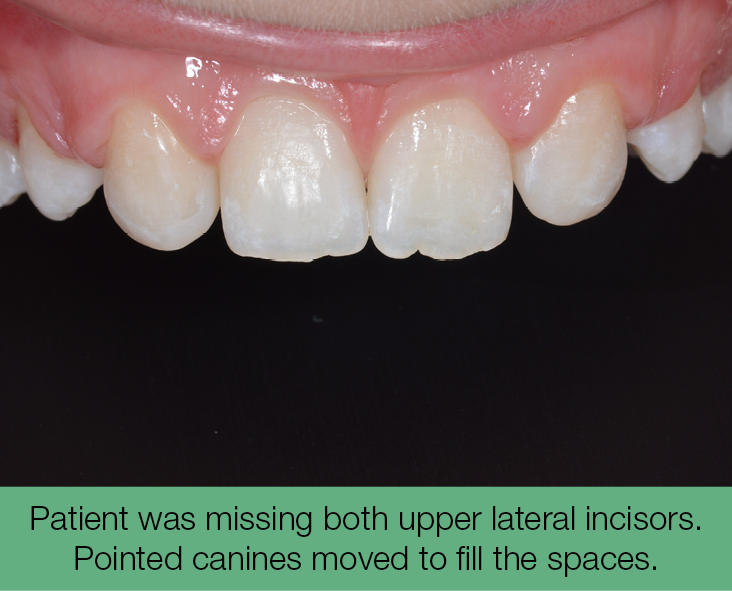 1. Patient was missing both upper lateral incisors. Pointed canines moved to fill the spaces