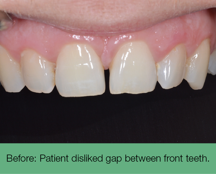 1. before - patient disliked gap between front teeth