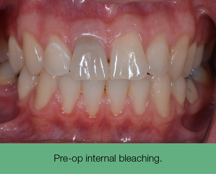 1. pre-op internal bleaching