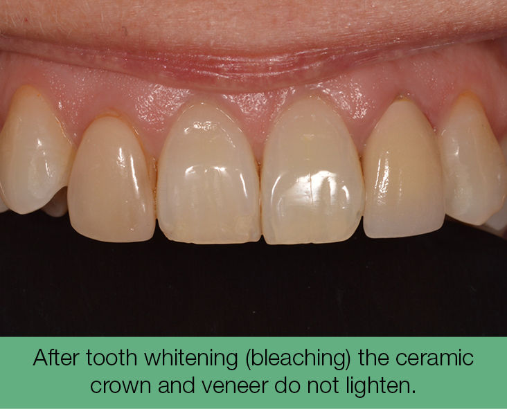 2. After tooth whitening