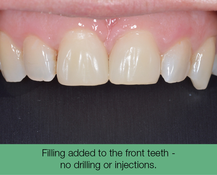 2. Filling added to the front teeth - no drilling or injections