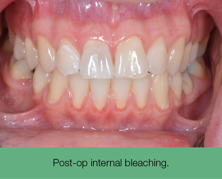 2. post-op internal bleaching