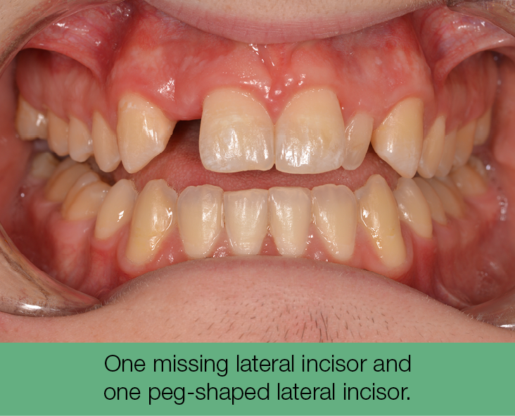 3. One missing lateral incisor and one peg-shaped lateral incisor