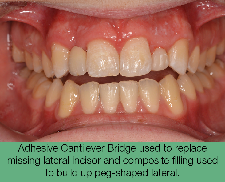 4. Adhesive Cantilever Bridge used to replace missing lateral incisor and composite filling used to build up peg-shaped lateral