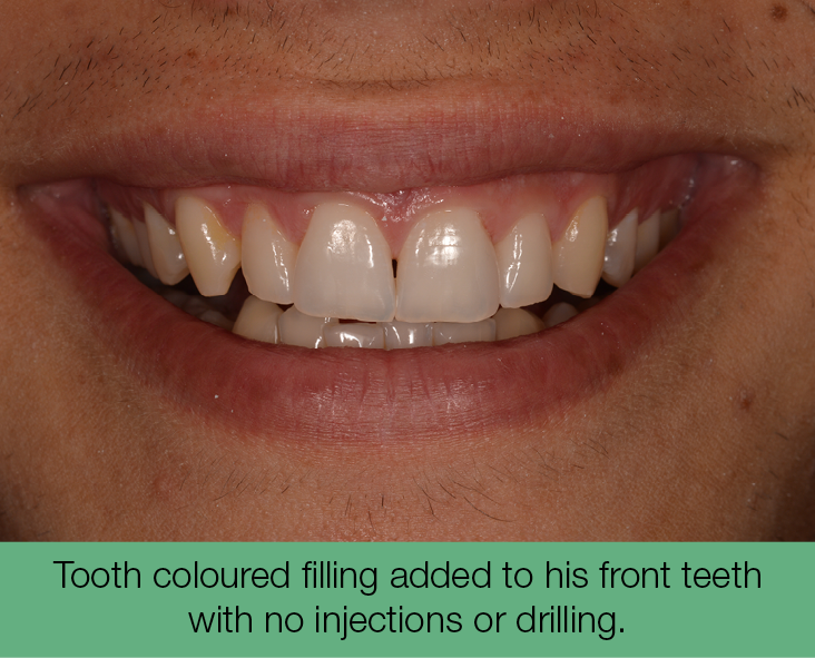4. Tooth coloured filling added to his front teeth with no injections or drilling